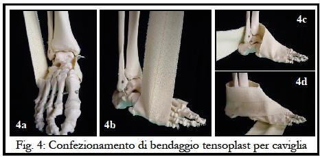 importante indicando la presenza di un considerevole sanguinamento da uno o più legamenti strappati dall osso.