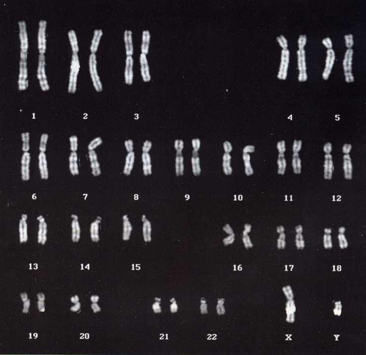 Eredità X-linked (o Eredità legata all X o eredità legata al sesso) Nella specie umana sono presenti, oltre ai 44 autosomi (22 coppie), 2 cromosomi sessuali che determinano il sesso: Femmine: