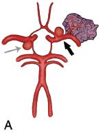 Lanzino Aneurysms Associated with Brain