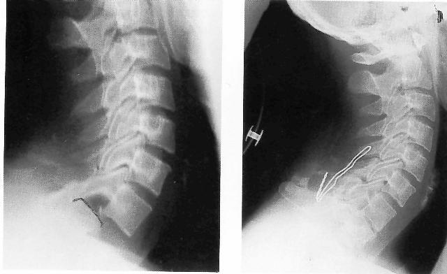 LESIONI AVULSIVE CERVICALI INFERIORI Processo spinoso di C7 più