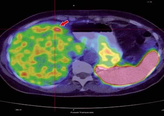 Un tumore neuroendocrino primitivo del fegato? Figura 1. Immagine PET-TC rilevata nella paziente nel gennaio 2008: recidiva di malattia a livello del III segmento epatico.