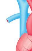 Arteria mammaria interna (arteria toracica interna) sinistra deviata come bypass nel ramo anteriore della coronaria sinistra Figura 6a: Bypass chirurgico mediante deviazione di arterie toraciche 5