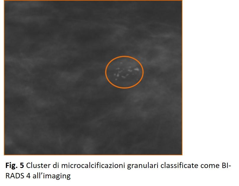 Fig.1 Cluster di microcalcificazioni granulari classificate