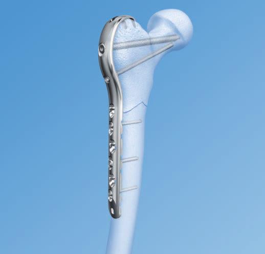 Tecnica chirurgica Applicare il centrapunte nella porzione filettata del foro nel corpo della placca.