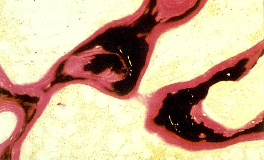 Osteomalacìa. Fotografia al microscopio ottico di cresta iliaca di un paziente osteomalacico (ridotta mineralizzazione nell osso adulto per carenza di Ca++ nella alimentazione).