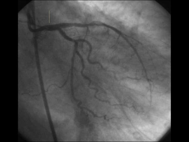 CASO CLINICO (2) Si è proceduto, in contropulsazione aortica, ad angioplastica del tronco comune con posizionamento di 2 DES su TC-IVA (Cypher 3.0/33) e CX (Cypher 2.