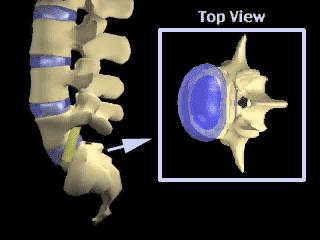 Si può quindi definire la disfunzione discale come una anomalia anatomica e funzionale del disco intervertebrale, tale da poter essere identificata come causa prevalente della lombalgia o