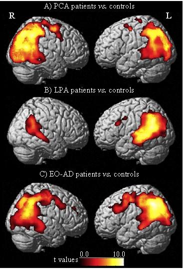 The neural correlates of the verbal working memory deficit in logopenic variant