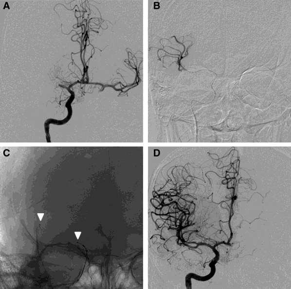 Acute ischemic stroke and stent-retriever mechanism