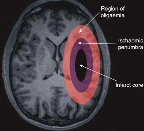 Ictus