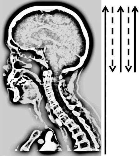 Angio TC: Tecnica trifasica Multiphase CT Angiography: A New Tool for the Imaging Triage of Patients with Acute Ischemic Stroke Bijoy K.