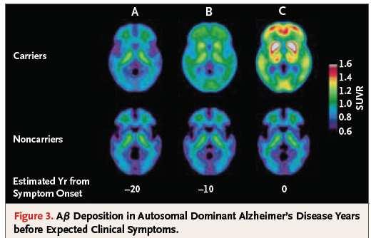 Dove e quando comincia l Alzheimer?