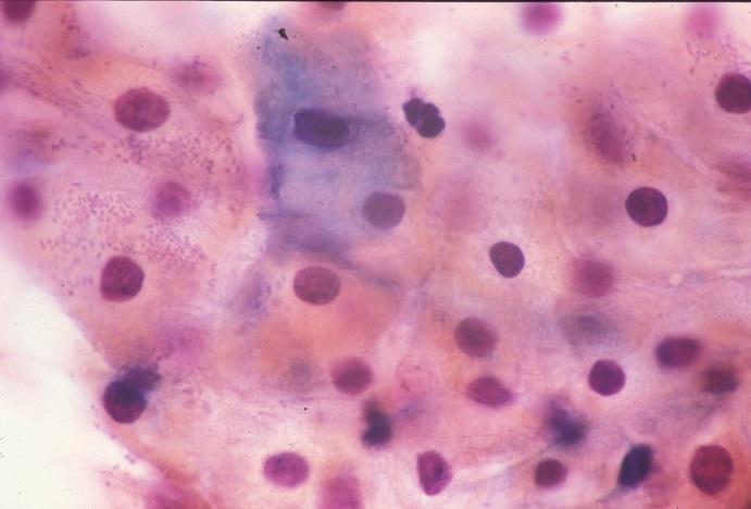 Cellule squamose atipiche di incerto significato (ASC-US) Il più delle volte l'ascus consiste in un ingrandimento del nucleo delle cellule squamose superficiali/intermedie con citoplasma maturo.