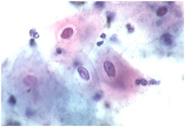 Criteri Le cellule sono isolate o riunite in lembi Le anomalie nucleari sono generalmente limitate alle cellule di tipo superficiale e grandi