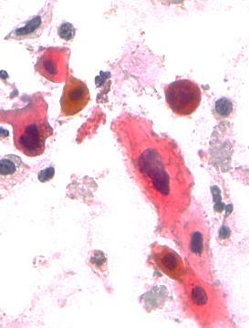 Le cellule hanno ampio citoplasma con una spiccata orangiofilia ed i nuclei appaiono aumentati di volume di forma irregolare con cromatina intensamente distribuita tanto da