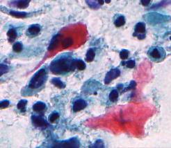 Criteri Carcinoma squamoso cheratinizzante Le cellule sono isolate, meno spesso in aggregati.