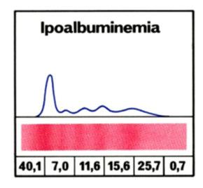 Albumina Nel siero la misura viene impiegata nella pratica clinica per la valutazione degli stati disprotidemici, ma va tenuto presente che l unica variazione clinicamente significativa è la sua