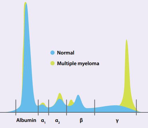 Gammapatia monoclonale Derivano da proliferazione clonale maligna o potenzialmente maligna (mentre i policlonali da processi infiammatori).