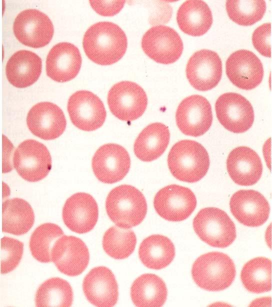 Eritrociti 5 milioni/mm 3, poco meno della metà del Vol del sangue Forma di lente biconcava, anucleati con diametro di 0.