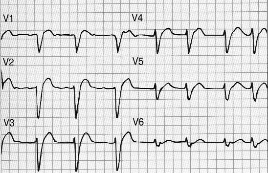 ostruzione del tratto di efflusso del ventricolo sinistro (es. stenosi aortica) o nell ipertensione.