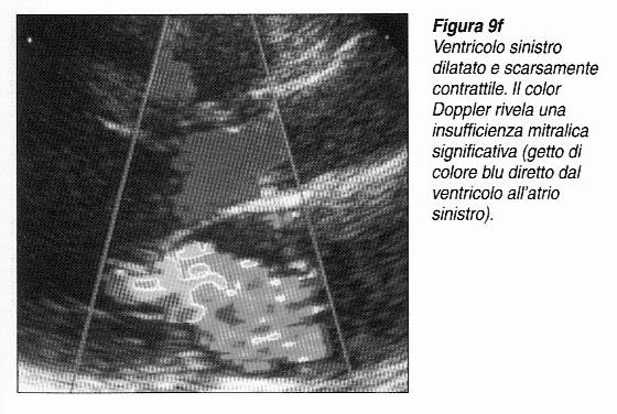 assottigliamento delle pareti e delle camere