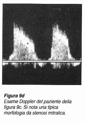 Diagnosticabili eventuali trombi intracavitari,