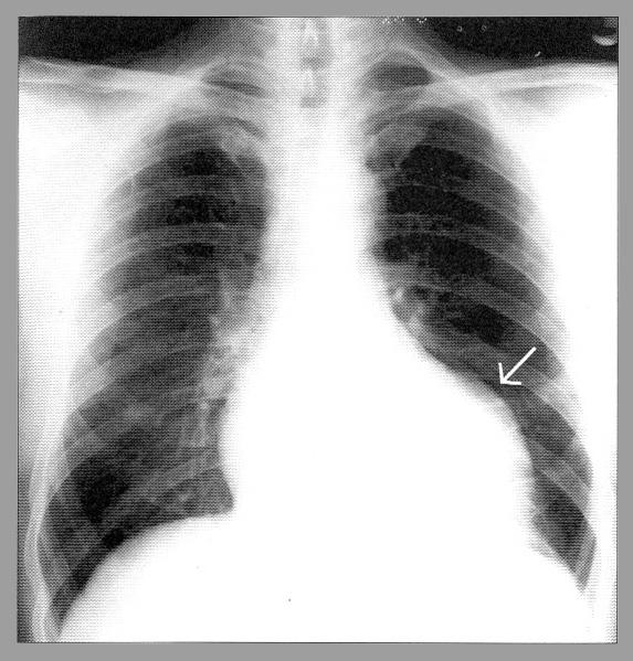 Rx torace Cardiomegalia ed ipertensione polmonare sono segni di una patologia cardiaca significativa.