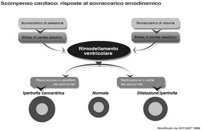 Il rimodellamento come meccanismo di compenso Il sovraccarico di pressione ed il sovraccarico di volume determinano un rimodellamento ventricolare Il sovraccarico di pressione determina ipertrofia