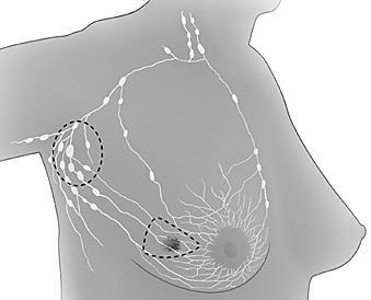 Axillary nodes dissection induce an accumulation of serous fluids named seroma The surgical removal of axillary nodes corresponds to a