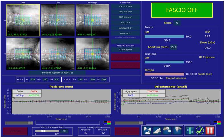 SPINE TRACKING Also in this case Cyberknife corrects each beam direction to accounts for residual desplacement of the patient during treatment CK corrects