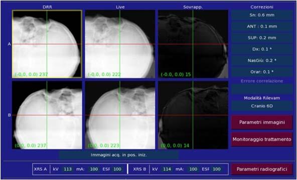 SKULL TRACKING The algorithm for skull tracking is