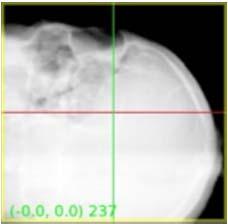 SKULL TRACKING DRR XRAY IMAGES Optimized Pattern Intensity for