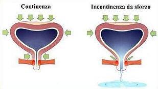 INCONTINENZA URINARIA DA SFORZO Perdita involontaria di urina a:raverso l uretra, associata ad un aumento della pressione intra- addominale!