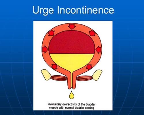 INCONTINENZA URINARIA DA URGENZA Perdita involontaria di urina secondaria a contrazioni detrusoriali non inibite Associata a s2molo intenso, improvviso e incontrollabile.