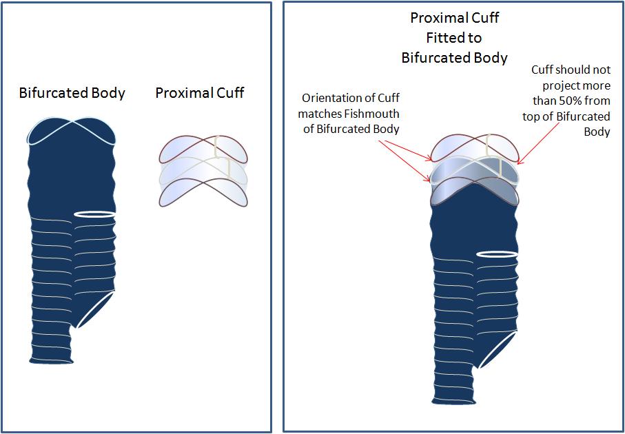 5 Convertitore Aorto-Uni-Iliaco (Convertitore AUI) Nell ambito del Sistema di protesi endovascolare per AAA flessibile Aorfix