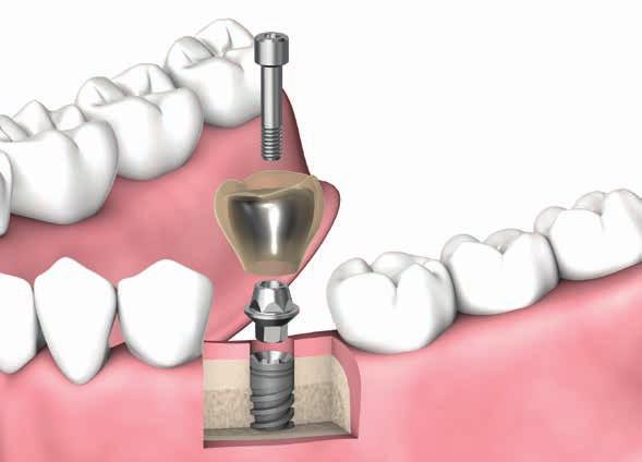 6 Controllo del manufatto protesico in lega: Prova metallo CLINICO Abutment HBC Altezze disponibili: 6040 0.5mm 6041 1.5mm 6042 2.5mm Viti LS 1. 2. 3. 4. Rimuovere la vite di guarigione.