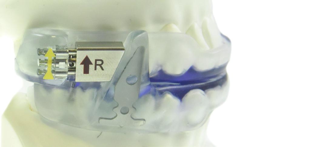 Il materiale trasparente con il quale sono costruite è compatibile con qualsiasi resina ortodontica acrilica, mentre i