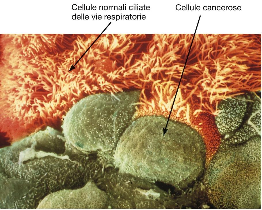 I linfociti T hanno anche la funzione di riconoscere cellule mutate (divisione e crescita cellulare) e distruggerle prima che queste si trasformino