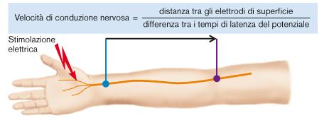 ELETTRONEUROGRAFIA Si valuta mediante elettrodi registranti di superficie posti lungo il decorso del tronco nervoso stimolato, il segnale elettrico