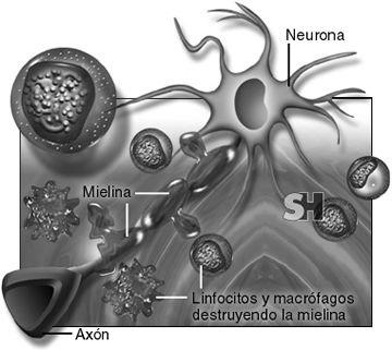 Malattie immuno-mediate mediate del SNC, del SNP e del muscolo scheletrico Sclerosi Multipla Poliradicolonevrite sub-acuta benigna