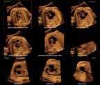 Misurazione del femore fetale con 5D LB 5D NT (Translucenza nucale) 5D NT supporta nella ricerca della sezione sagittale mediana del feto che viene prima
