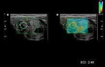 EFFICIENZA DIAGNOSTICA E-Breast (ElastoScan per la caratterizzazione di lesioni mammarie) Con la tecnologia E-Breast l utente può ottenere automaticamente un rapporto