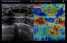 E-Thyroid (ElastoScan per la caratterizzazione di noduli tiroidei) La tecnologia E-Thyroid consente di effettuare una valutazione più obiettiva delle lesioni della