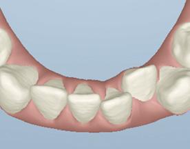 È più predicibile trattare l affollamento con gli aligner Invisalign se I denti anteriori sono lingualizzati o diritti.