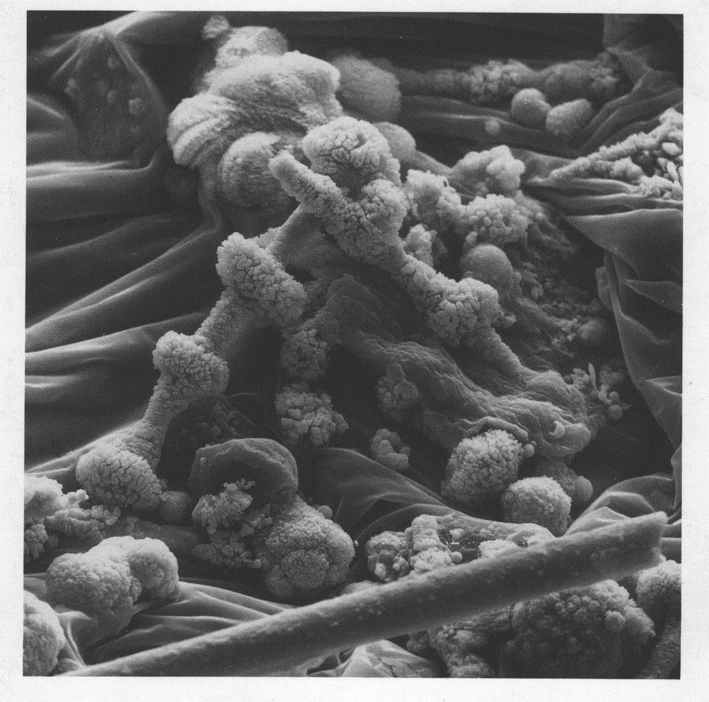 Questa immagine, tratta dalla copertina del volume "Health effects of mineral dusts" mostra un campione di tessuto polmonare con fibre di amianto rivestite da