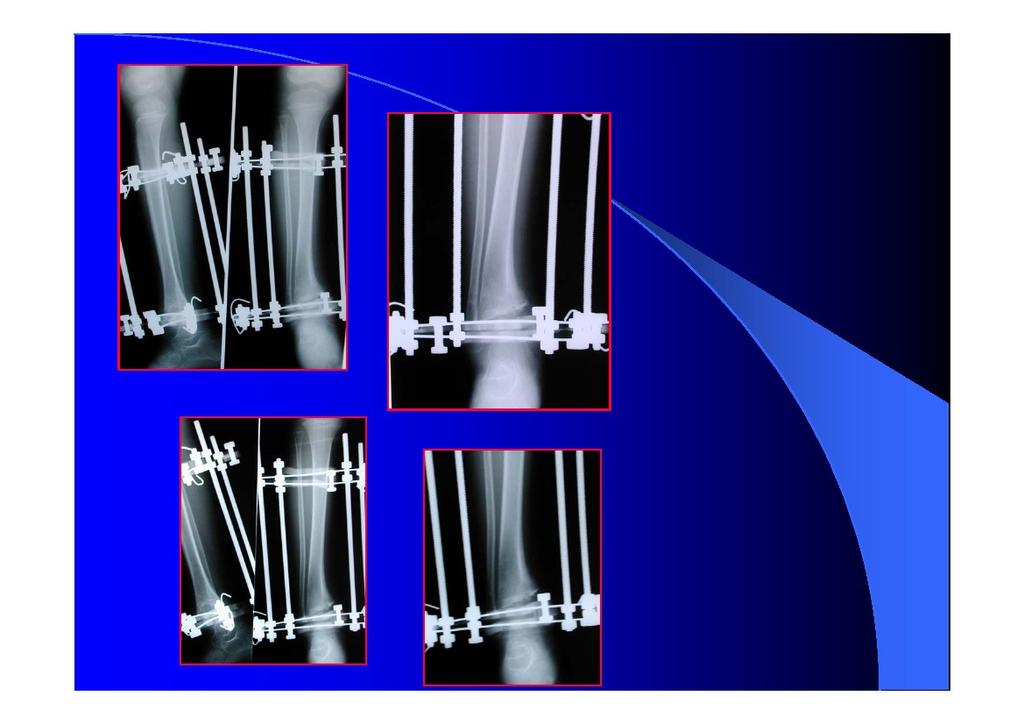 Controllo radiografico del 30/05/01