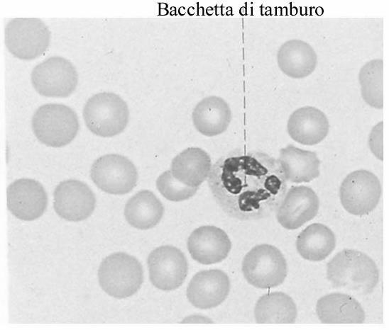 granulocito neutrofilo La bacchetta di tamburo ( drumstick ) equivalente al corpo di Barr è presente in 1 su 36