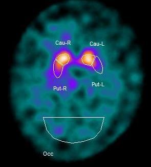 TDPD: Malattia di Parkinson Tremorigena con