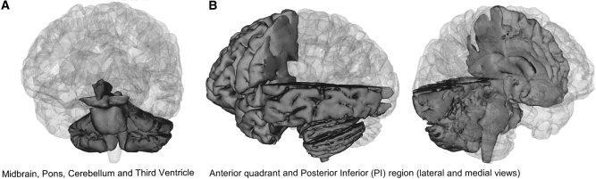 I BIOMARCATORI NELLA DIAGNOSI DI PSP. LEVEL 1: RESEARCH TOOL GROUP-LEVEL EVIDENCE THAT A BIOMARKER IS ABNORMAL IN PSP-RS Subject Group ROI volumes, ml PSP MSA-P PD Control Whole brain volume 1085.