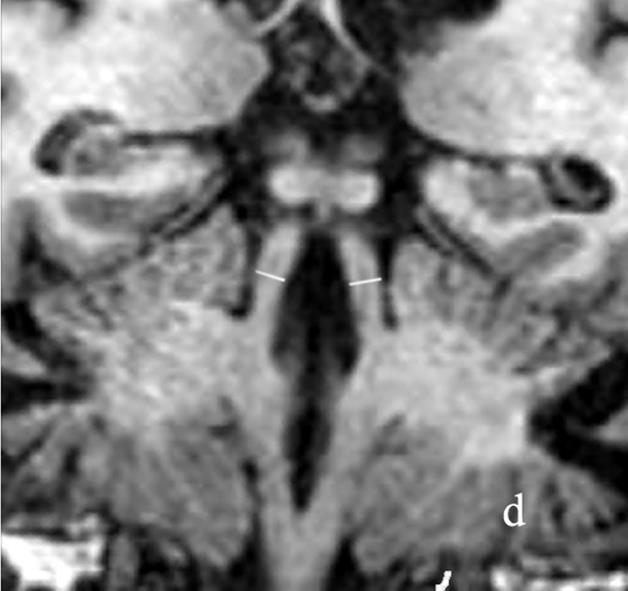 , 2008 Superior cerebellar